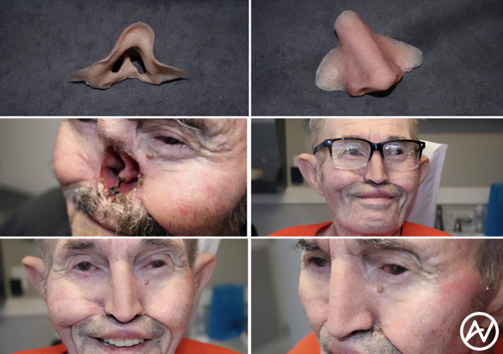 Photo of Nasal Prosthetics